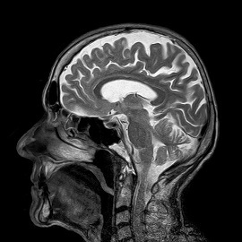 brain mri