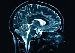 MRI of a human brain